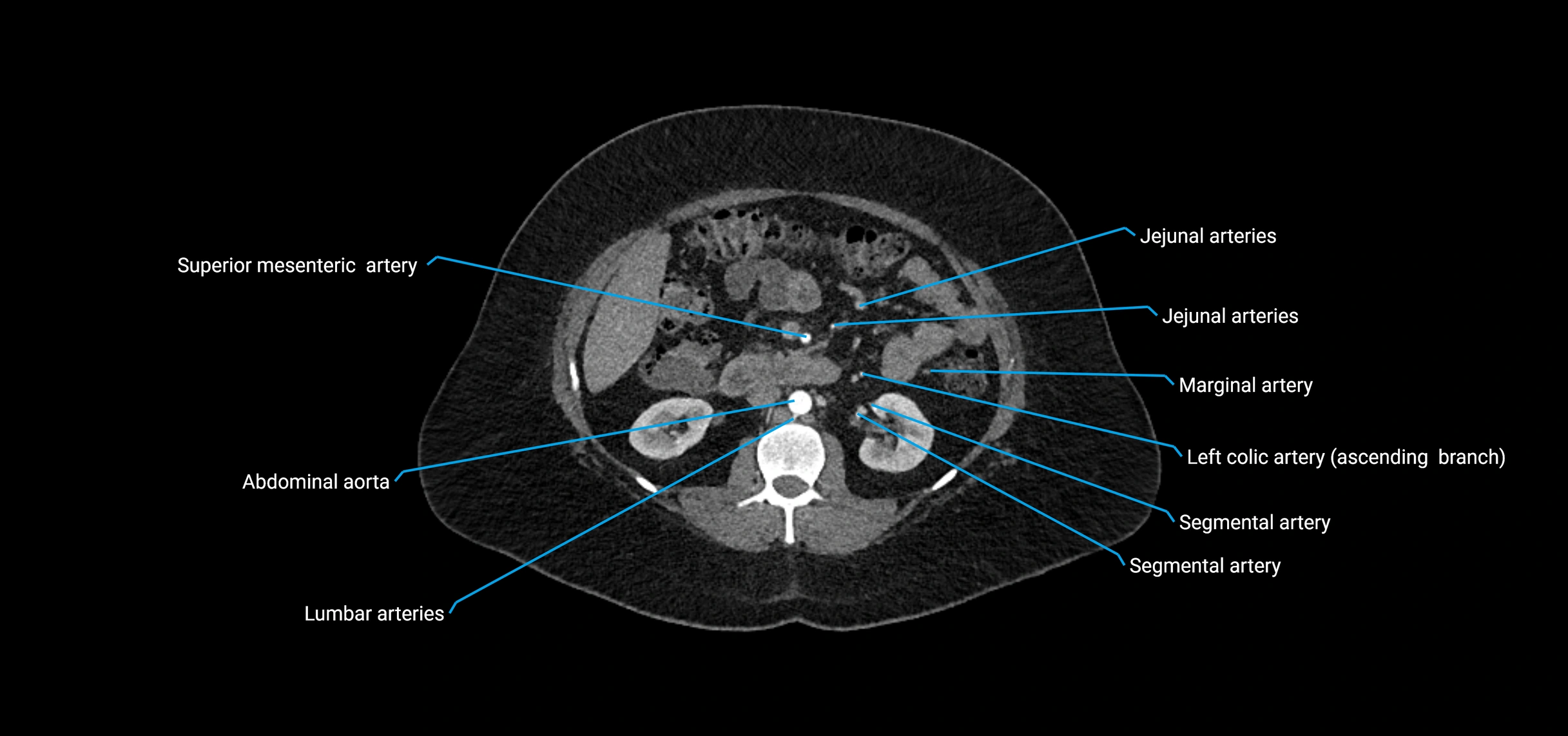 CTA abdomen axial cross sectional anatomy labelled image_81 (2).webp